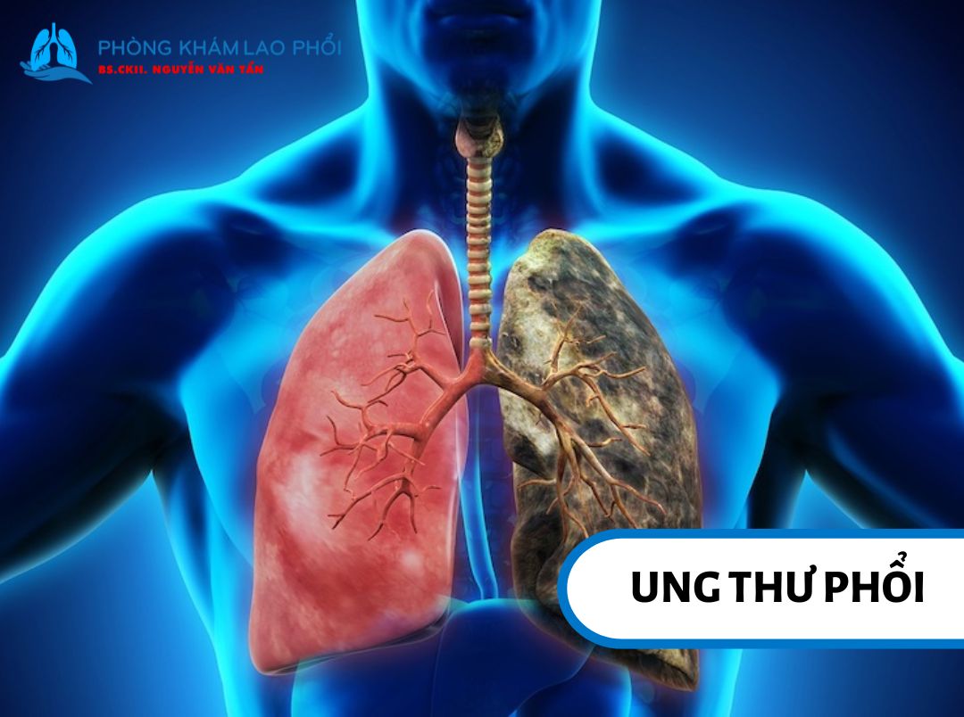Khối u ác tính hình thành và phát triển trong phổi