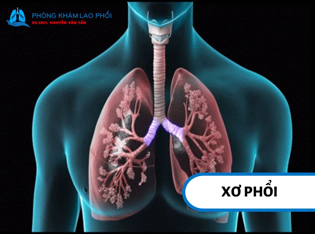 Mô phổi bị tổn thương và hình thành các vùng xơ hóa