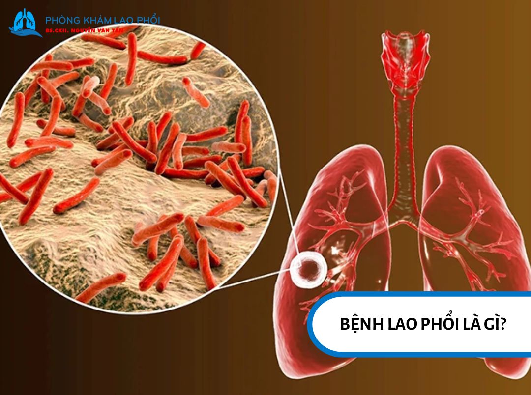 Lao phổi là thể lao phổ biến nhất, chủ yếu gây tổn thương phổi và lây qua không khí