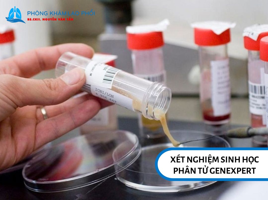 GeneXpert giúp phát hiện vi khuẩn lao và kháng rifampicin trong khoảng 2 giờ