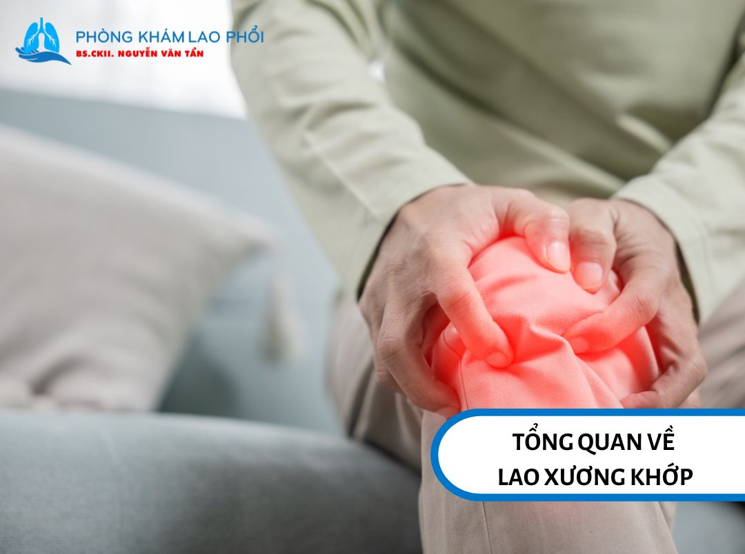 Lao xương khớp xảy ra khi vi khuẩn lao tấn công vào xương và khớp thay vì phổi