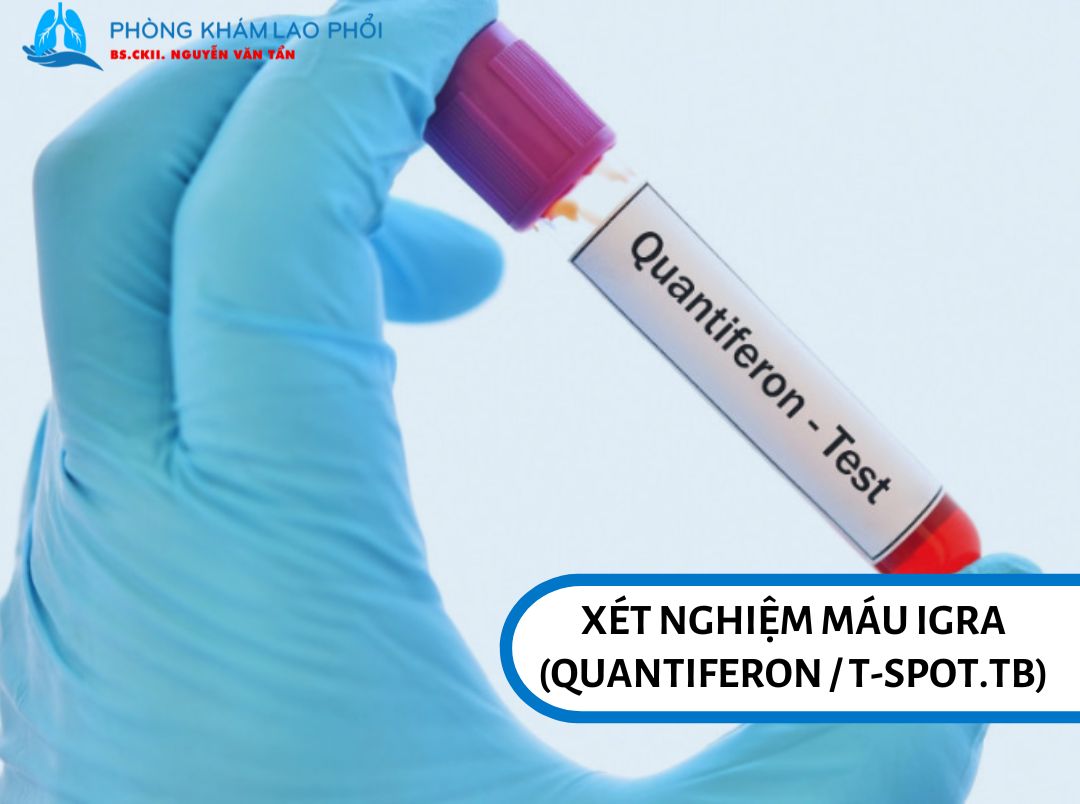 Xét nghiệm IGRA đo phản ứng miễn dịch với vi khuẩn lao, giúp phát hiện đã từng nhiễm nhưng không phân biệt lao hoạt động hay tiềm ẩn